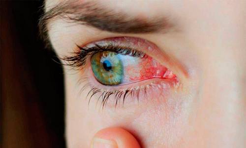 Самые распространенные заболевания глаз
